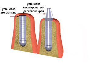 Цены на имплантацию в клинике «ЭкоДент»