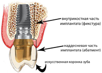 Цены на имплантацию в клинике «ЭкоДент»