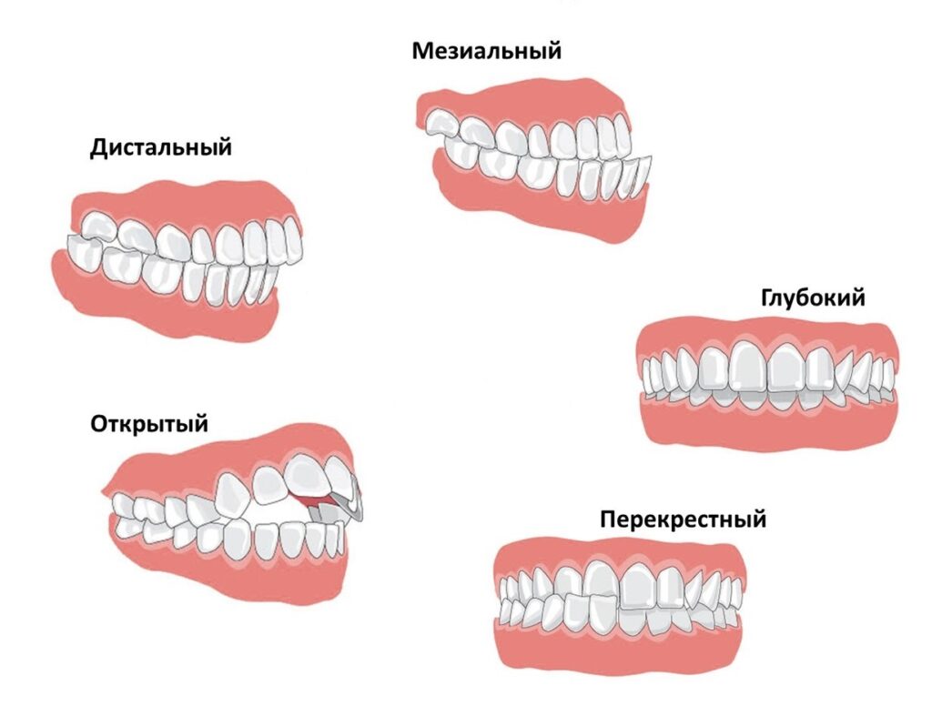 Исправление прикуса в Ясенево