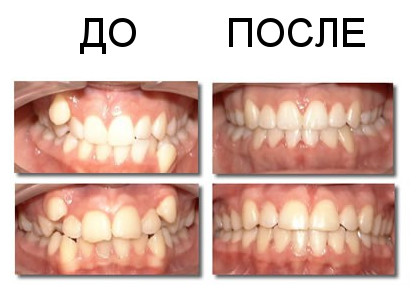 Исправление прикуса в Ясенево